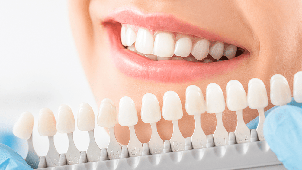 Close-up of a patient’s smile with a shade guide held against their teeth for color matching